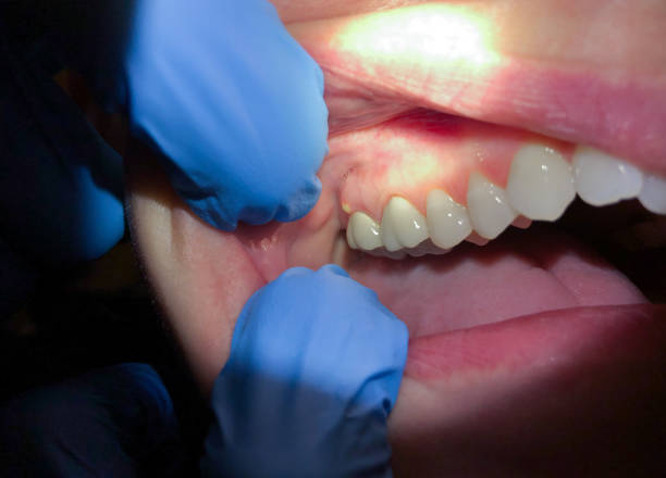Best Emergency Treatment for Dental Infections or Abscesses in Epworth, IA